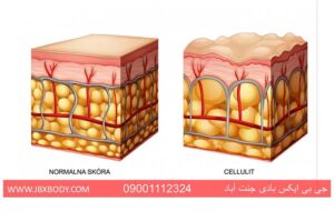 پوست نرمال و پوست سلولیتی